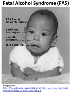 fetal alcohol syndrome facial features